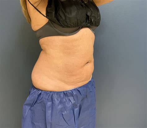 coolsculpting st louis|COOLSCULPTING ® FAT REDUCTION IN ST. LOUIS, .